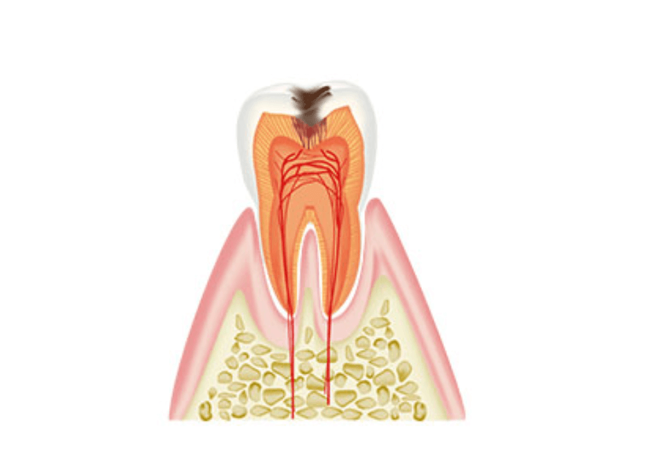 C2:中度（象牙質にまで及んだ虫歯）