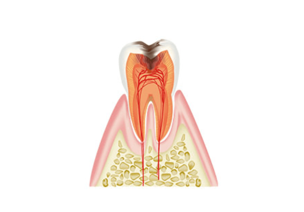 C3:重度（歯の神経に達する虫歯）