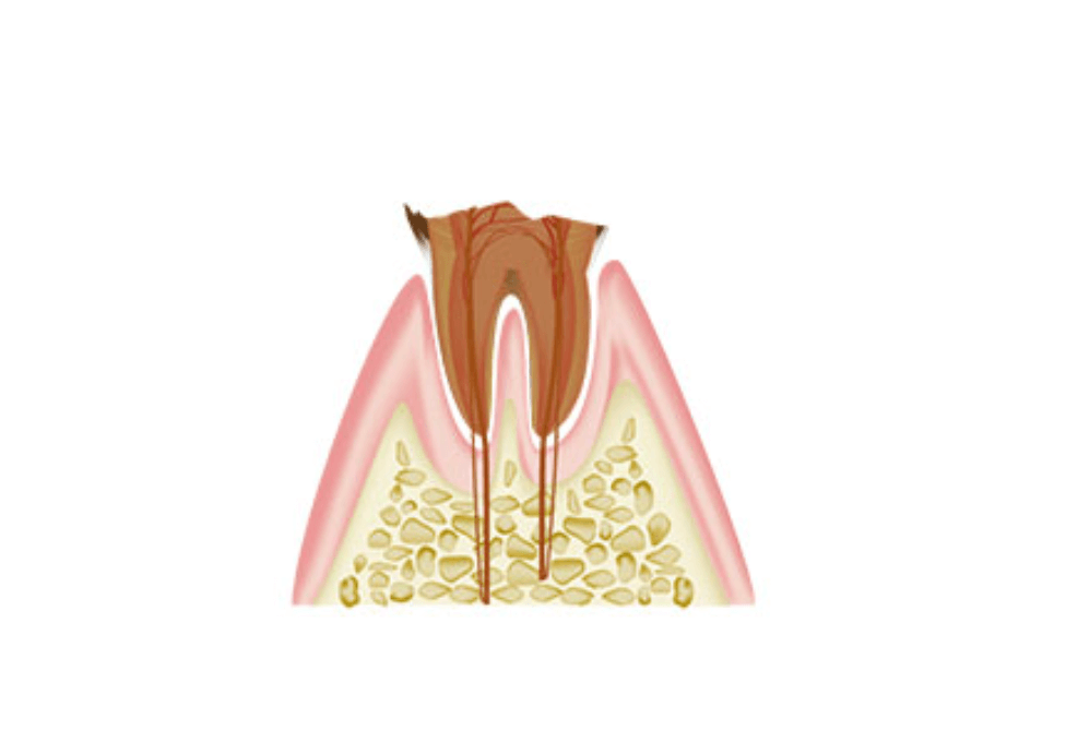 C4:末期（歯根だけが残っている虫歯）
